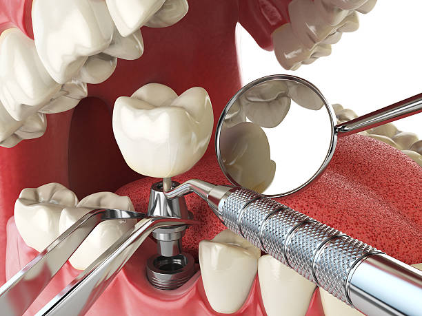 Best Emergency Treatment for Dental Infections or Abscesses in Hoboken, NJ